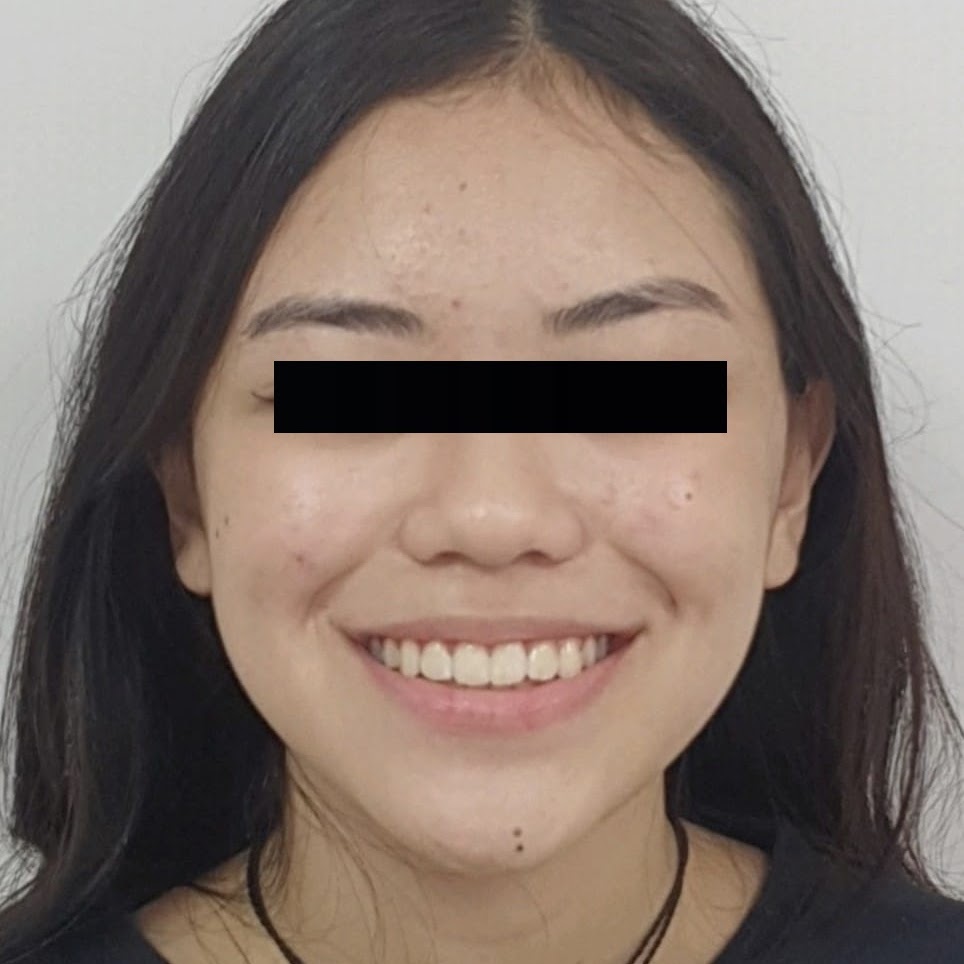 Antes (rosto)