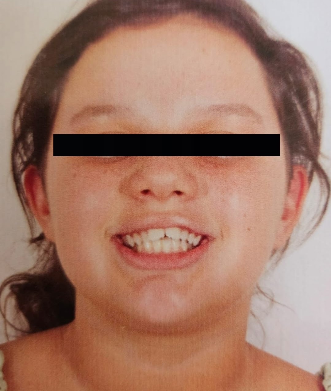 Antes (rosto)